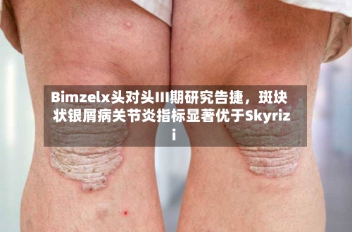 Bimzelx头对头III期研究告捷	，斑块状银屑病关节炎指标显著优于Skyrizi-第3张图片